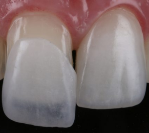 Lente de Contato Dental